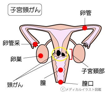 子宮頸がん