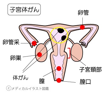 子宮体がん