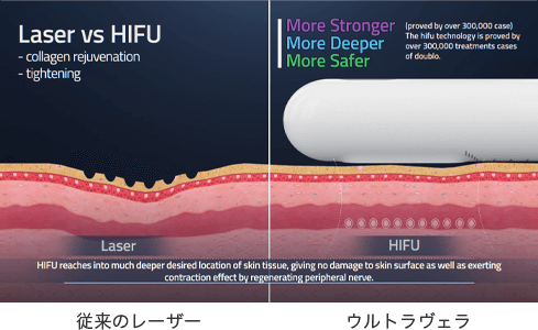 HIFUについて